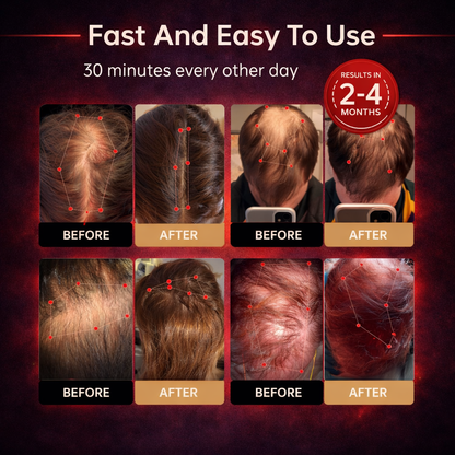 🧔Last Day:63% off 🔥Red Light Therapy Regrowth Cap
